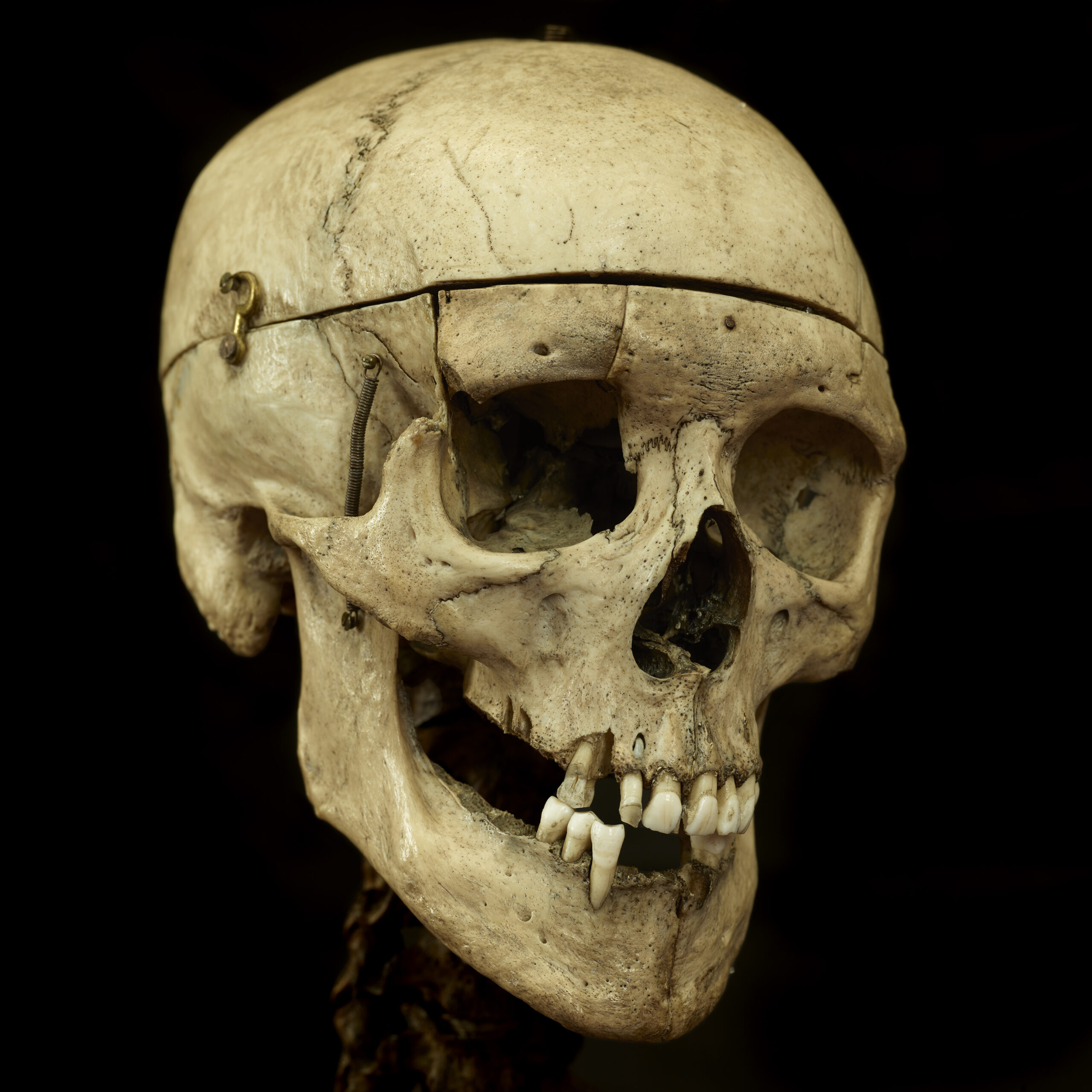 Colour image of a skull on black background, facing forwards angled to the right (to the skeleton's left). Metal joins and springs can be seen holding the skull together