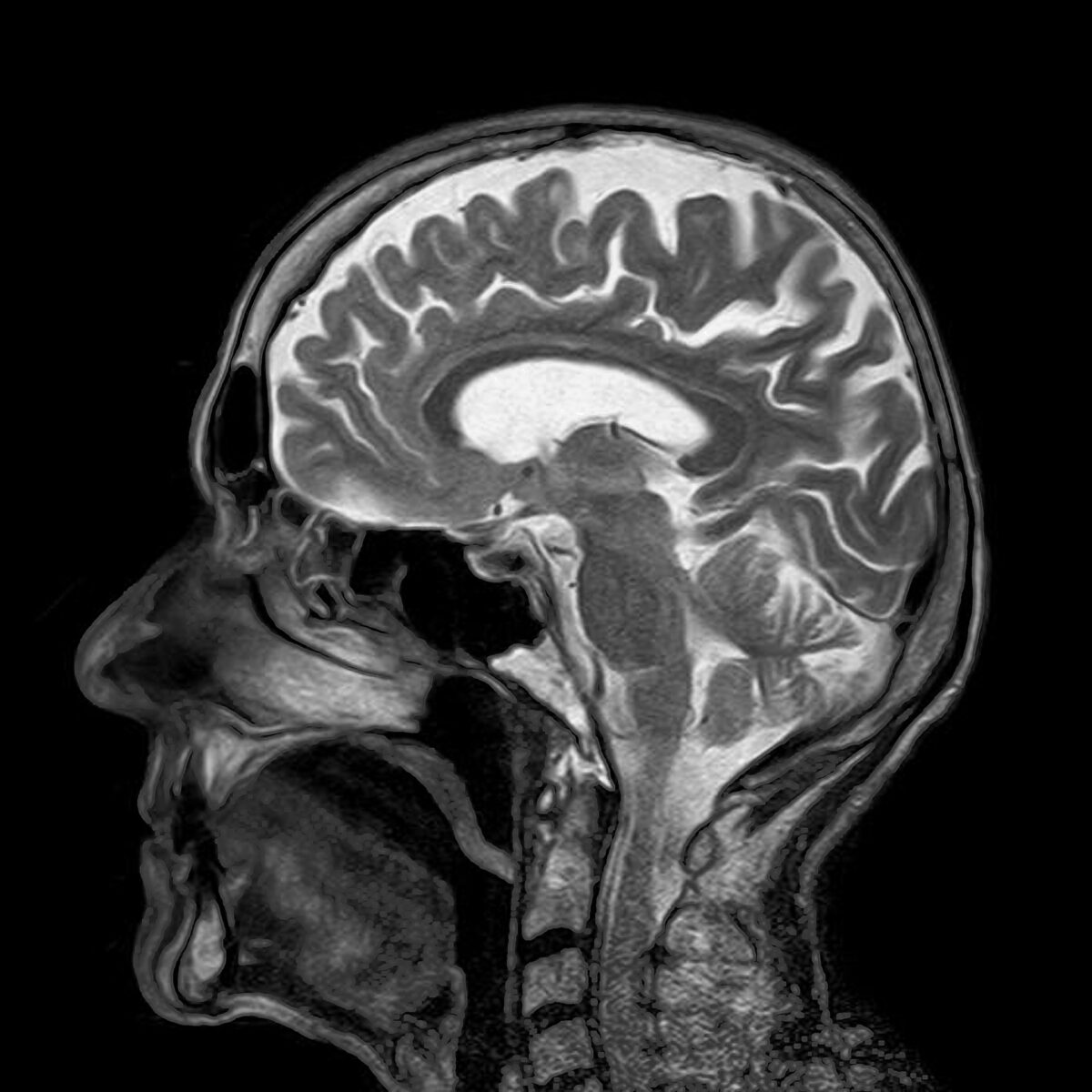 MRI scan of human head