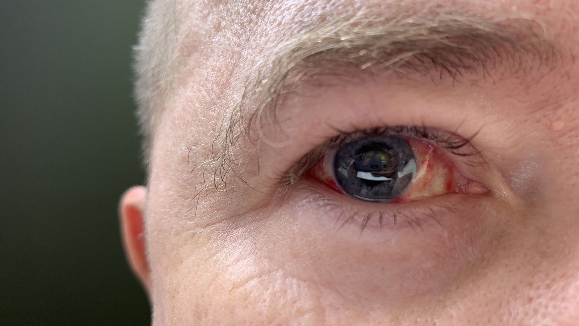 Extreme close-up of Stewart's right eye showing redness and dilated pupil.