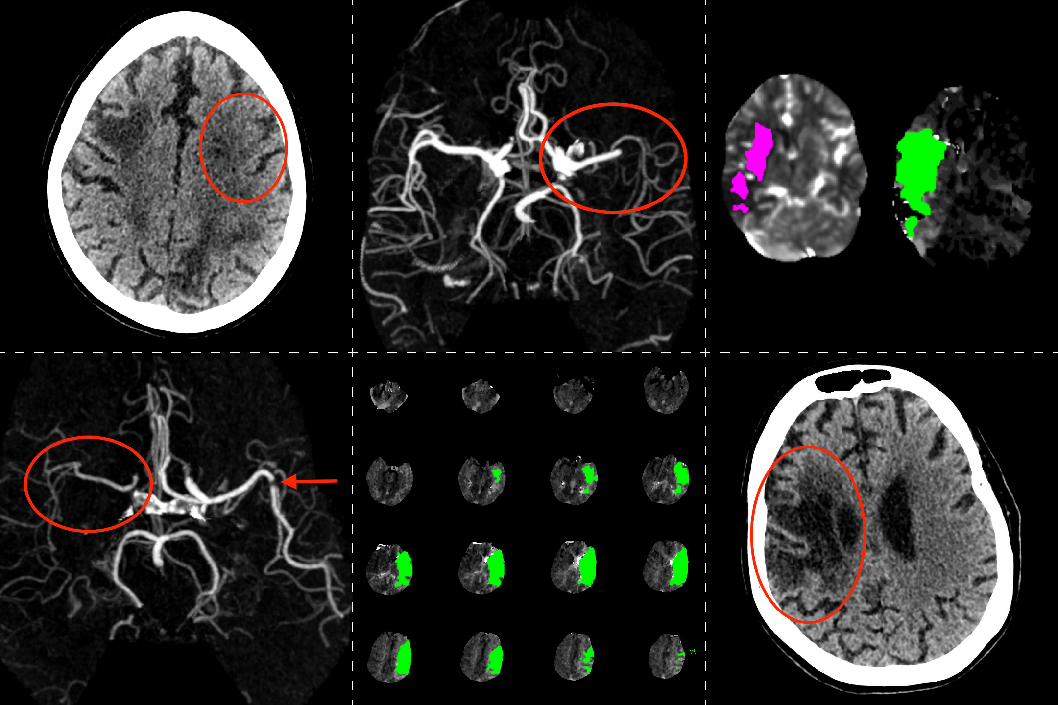 Brain imaging scans including non contrast CT head, CT Angiograms and advanced CTP