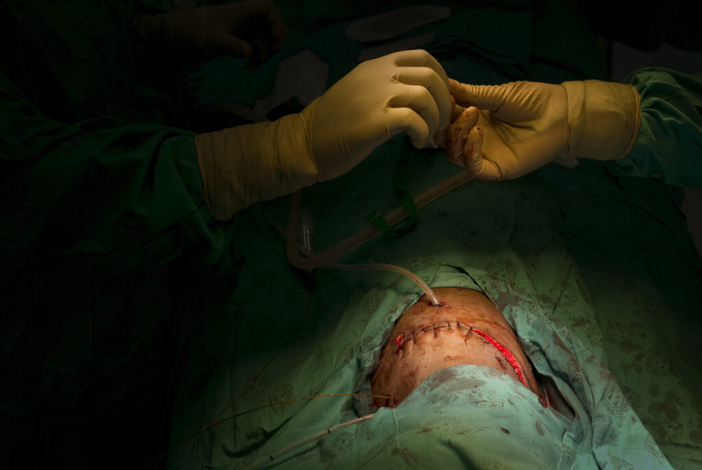 One pair of gloves surgeon's hands above patients body