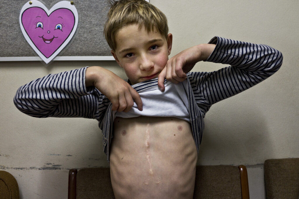 Young patient with raising up his top to show healed scar on his chest