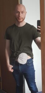 Nathan Constantine-Cooke with a stoma