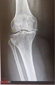My knee joint before the operation xray of right knee showing osteoarthritis